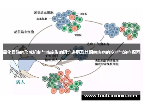 晶化骨髓的形成机制与临床影响研究进展及其相关疾病的诊断与治疗探索 晶化骨髓的形成机制与临床影响研究进展及其相关疾病的诊断与治疗探索